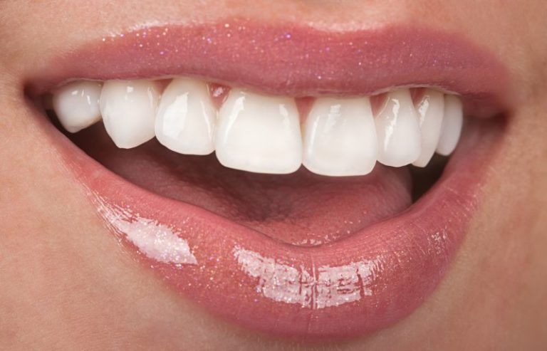 A Step-By-Step Guide To Getting Veneers | Oceanside Family Dental